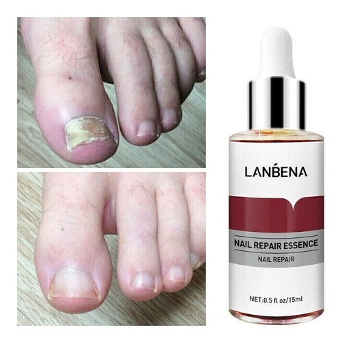 1/2PCS Fungal Nail Essence Repair Serum Nail File Hand/Foot Treatment NailRepair - Picture 9 of 13
