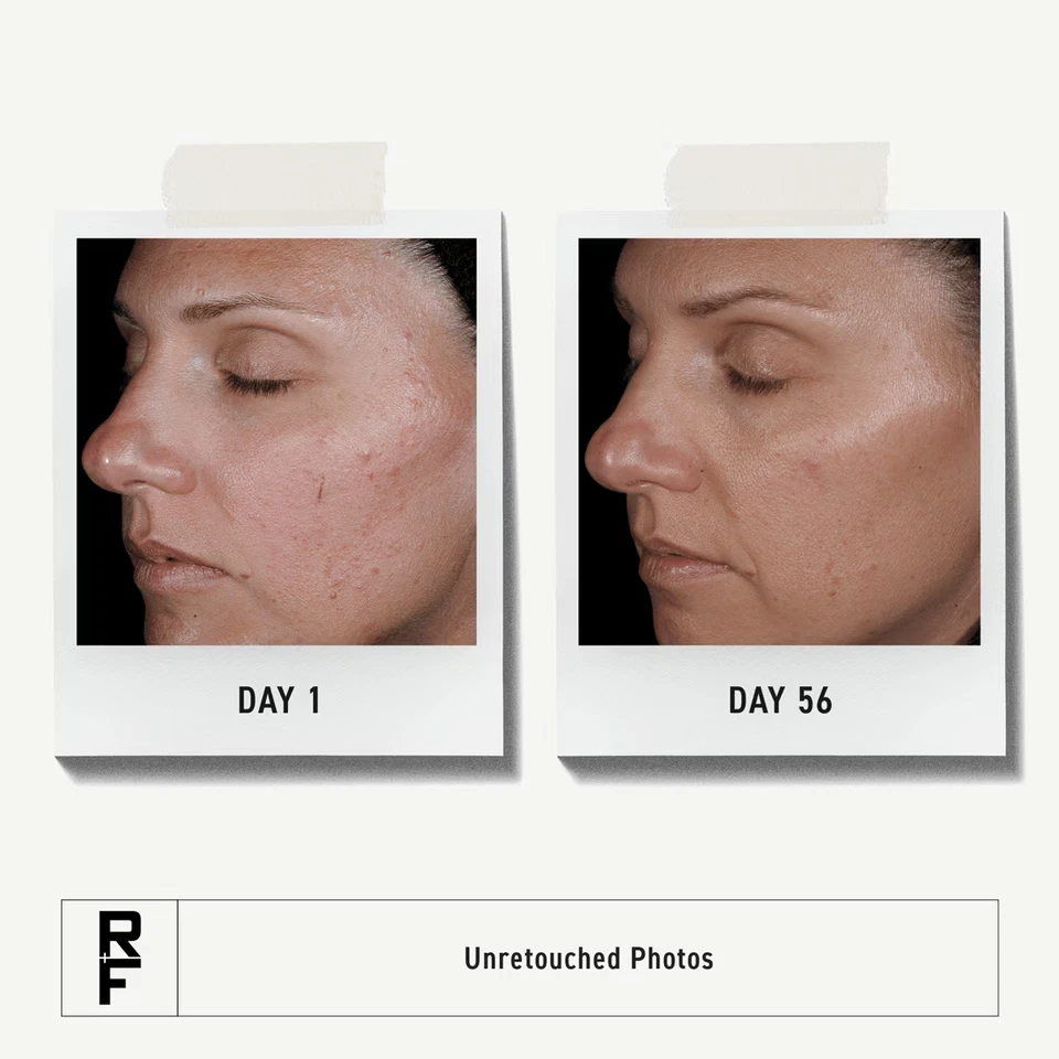 RODAN + FIELDS UNBLEMISH Tratamiento Doble Intensivo para el Acné Foto 4 de 4