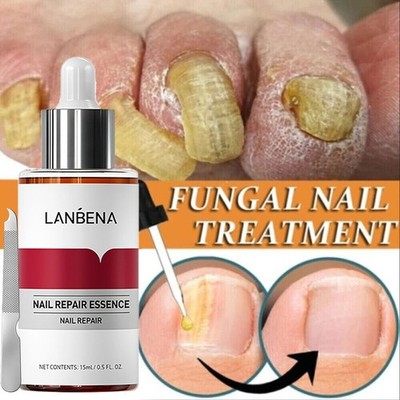 Nail Repair Serum Fungal Nail Treatment Liquid Remove Onychomycosis Toe Essence