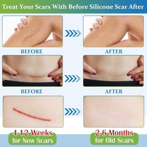Silicone Scar Sheets, Medical Grade Silicone Scar Tape, Reusable Removal Improve - Picture 2 of 7