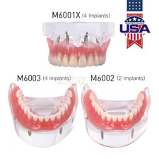 Dental Implant Teeth Model Demo Overdenture Restoration 2 / 4 Implants Upper Low