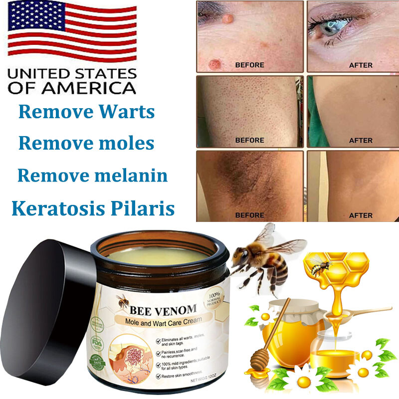 Bee Venom Skin Tag Removal Treatment Cream Body Care Mole Corn