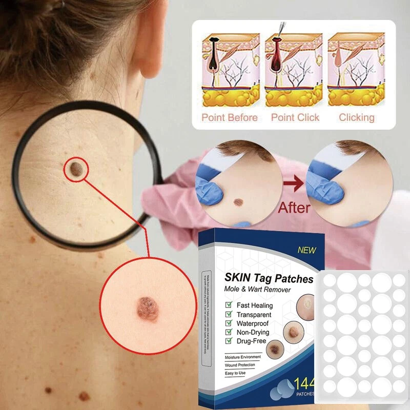 Skin Tag Remover Patches Quick Effective Mole and Wart Pad Removal Sticker US - Image 2 of 4