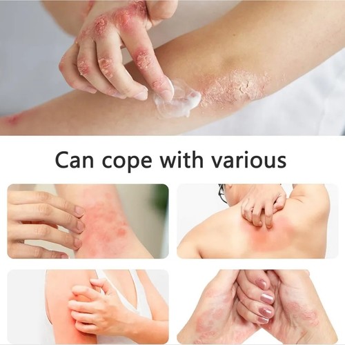 2 Stück TODAHOF Bienengift Psoriasis Behandlung Creme Hauterkrankungen Rosacea Ance - Bild 7 von 16