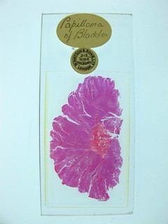 Oversized antique microscope slide by Watson. "Papilloma of Bladder".
