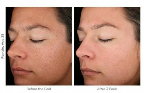 MicroDermabrasión Crema Cristales Exfoliante Anti Envejecimiento Arrugas Rejuvenecimiento Exfoliante Foto 4 de 4