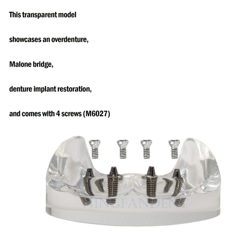 US Dental All-on-4 Overdenture Implant Model, Upper/Lower Jaw-Clear,With 4 Screw - Picture 21 of 51
