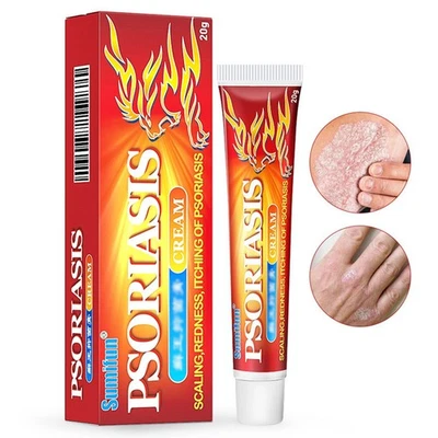 UNGEBRANDET 20G Ekzem Dermatitis Psoriasis Haut Gel Creme für Rötung Juckreiz der Psoriasis