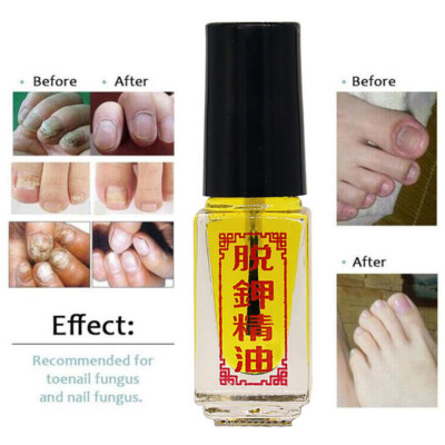 3 Days Effect Really Work Nail Treatment Removal Onychomycosis Paronychia Oil