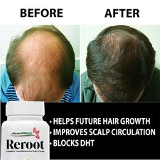 DHT BLOCKER Herbal HAIR Fast GROWTH PILLS Prevent Anti Loss Stimulate Fuller USA