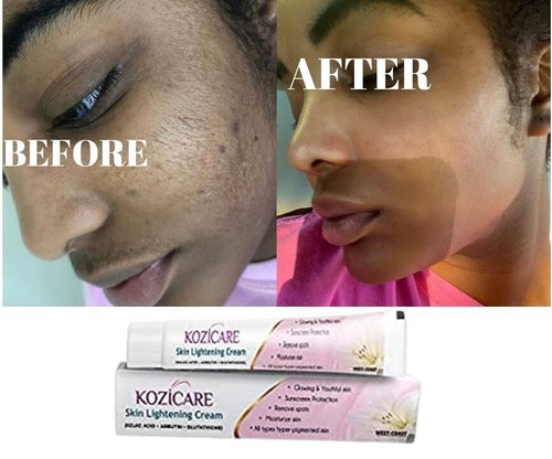 best bleaching cream for brown spots