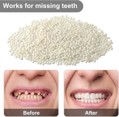 25g Dental Temporary Teeth Repair Replacement Denture Material Fitting Beads