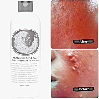 Explore Home Remedies for Skin Problems with Black Soap