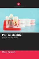 Charu Agrawal | Peri-Implantite | Taschenbuch | Portugiesisch (2023)