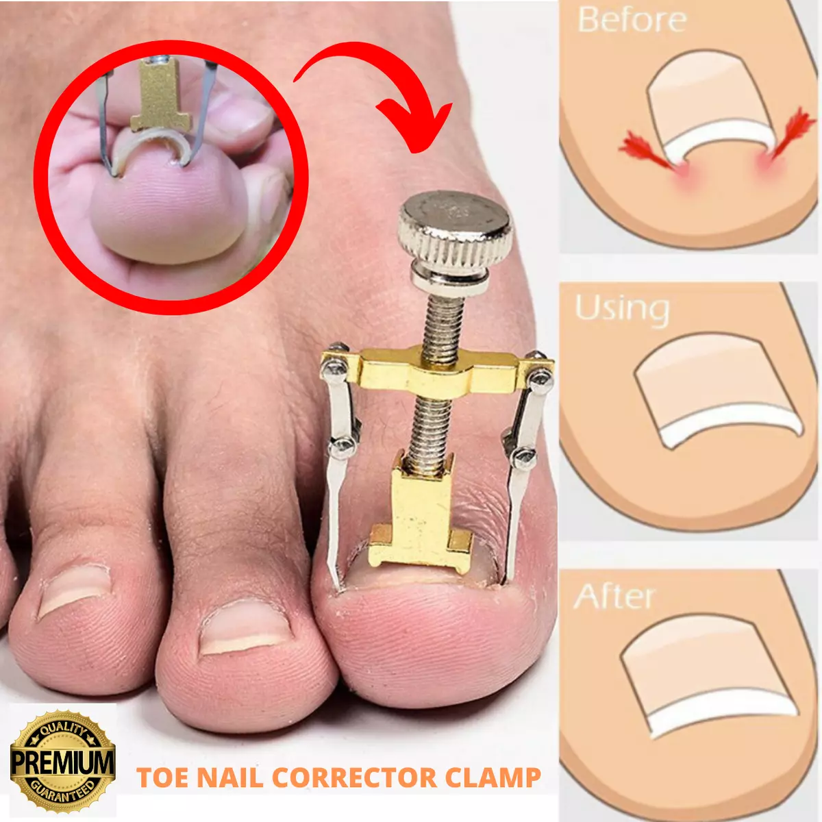 INGROWN TOENAIL TREATMENT, Ingrowing Toe Nail Correction Tool Pedicure  Fungal