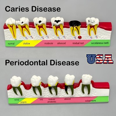 Dental Teeth Model Periodontal Caries Disease Dentoform Typodont Study Teach