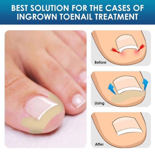 HOT Nail Correction Sticker Ingrown Toenail Corrector Patch Treatment Recover - Picture 3 of 17