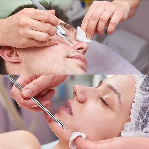 Blackhead Estrattore Punti Neri strumenti Rimozione 4 Pezzi Pinzetta Punti - Foto 6 di 24