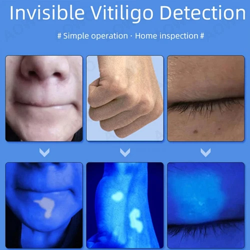 UV Woods Lamp Examination Dermatology Skin Anyalyzer For Vitiligo CE FDA - Picture 4 of 11