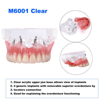 Dental Implant Teeth Model – Overdenture Restoration With 3/4 Implants – Upper/Lower Demo