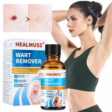 Wart Remover Liquid Skin Tag Mole Remover Eliminate Foot Corn Warts Unisex 30ML