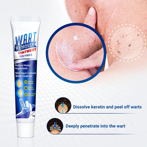 Warzen Entfernung Haut Tag Behandlung Creme Wart Remover Warze Entferner - Bild 8 von 21