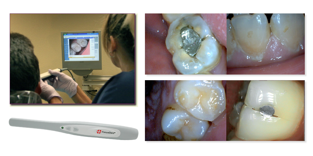 FocusDent MD740 Intraorale Kamera USB Intraoral Camera Intraoralkamera