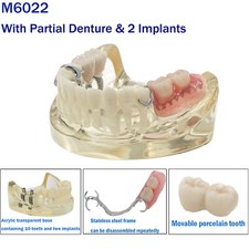 Dental M6022 Typodont Implant Restoration Teeth Model with Partial Dentures