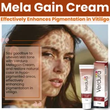 Mela Gain Cream 75g Pack of 2  Vitiligo Care Cream Good for Skin Reduce Spots
