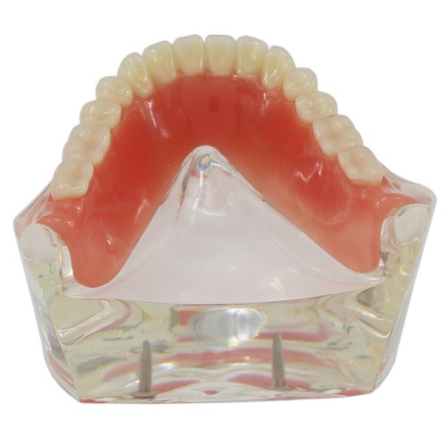 Demo modello denti Typodont restauro overdenture dentale con 2 impianti modello - Foto 5 di 12