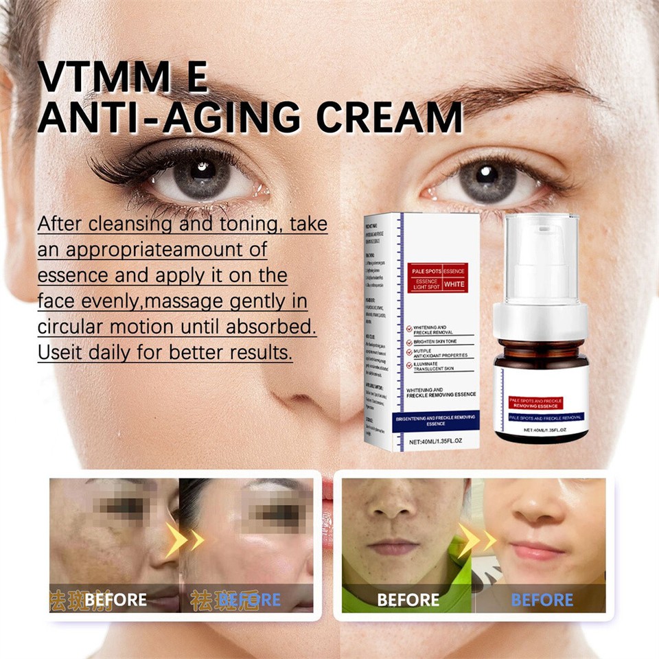 Whiting And Freckle Removing Serum Cream Dark Spot R𝐞mover Freckle