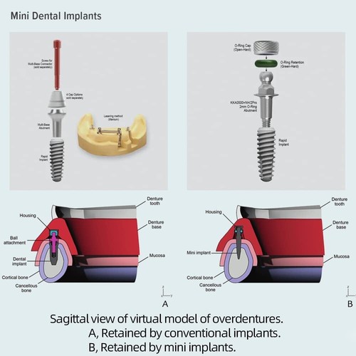 Kit de herramientas de repuesto para junta tórica Buna-n 3 tamaños convenientes mini implantes dentales nuevo - Imagen 8 de 8