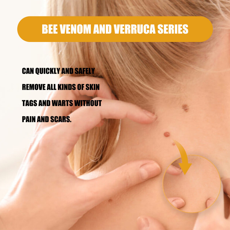 Best Bee Venom For Skin Tags Bee Venom Skin Tag Removal Treatment Cream Body Care Mole Corn Wart