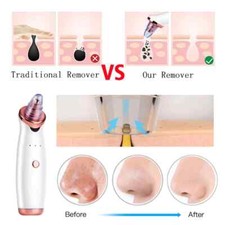 Blackhead Remover