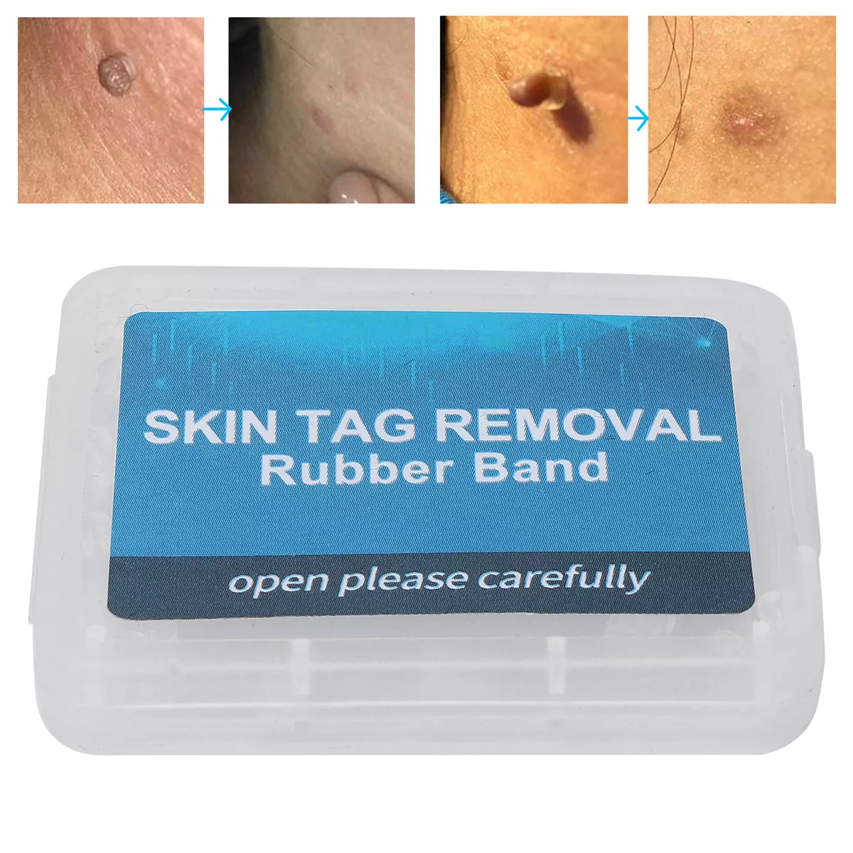 30Pcs Skin Tag Removal Rubber Bands Micro Band Non Toxic Face Care Mole Wart