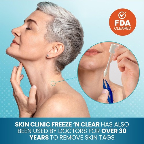 Trusted Cryogenic Skin Tag Remover - 8 applicatori e pinzette di precisione inclusi - Foto 4 di 9