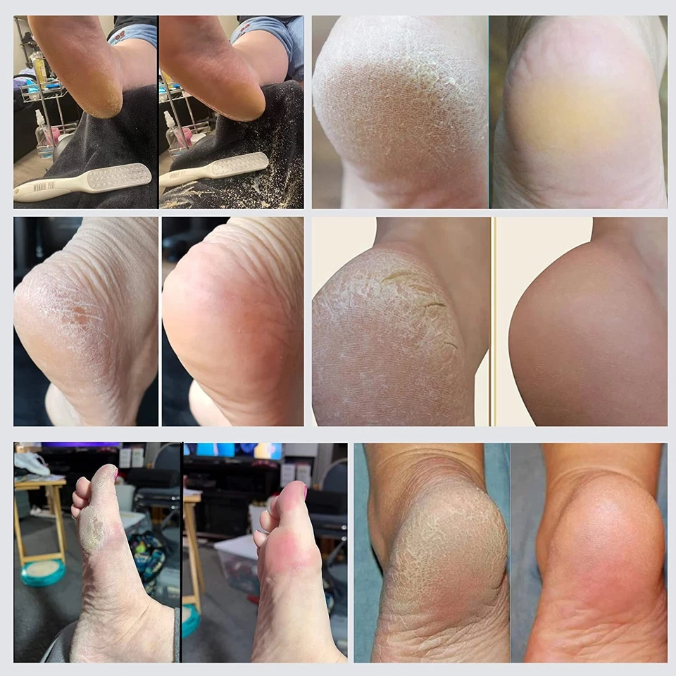 Doppelseitige Metall Fußfeile Edelstahlfüße Hornhautentferner Made in Germany - Bild 2 von 4