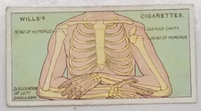 Wills's First Aid DISLOCATED SHOULDER Vintage Medical Cigarette Card #45