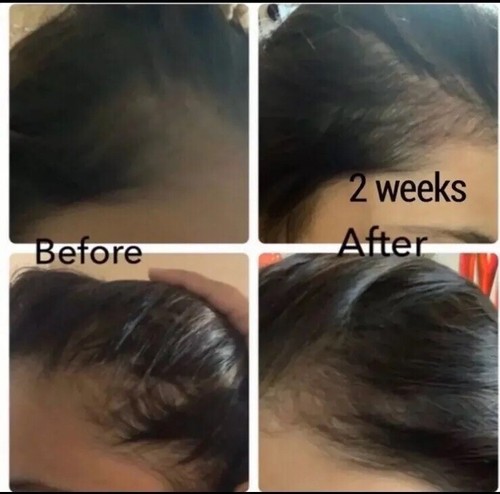 Organic Hair Growth and Anti Hair Loss Oil 30 Ml For Men & Women - Picture 5 of 13