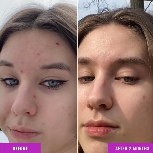 Niacinamide Serum - 10% Niacinamide to Target Acne, Nourishment, and Skin Tone - - Picture 4 of 11