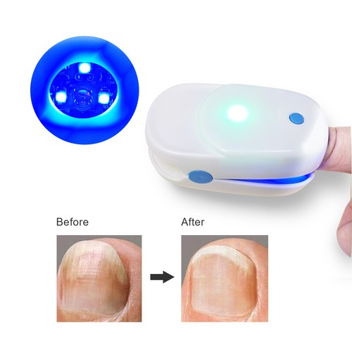 Nail Fungus Treatment For Toe & Finger Nail Fungal Infections Cold Laser Device - Picture 2 of 12