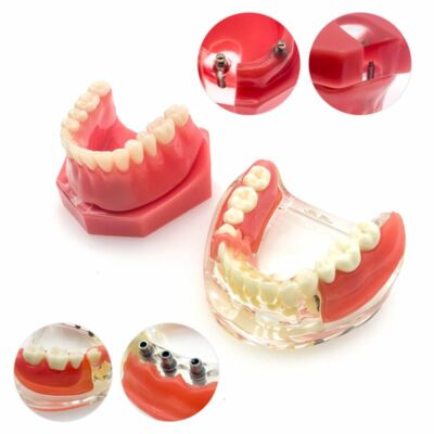 Dental Teaching Model - Single Piece Implant & Bridge Demonstration Tooth With Brackets 2 thumbnail image