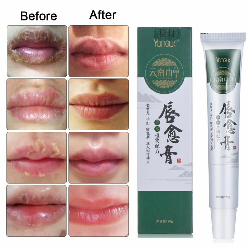 AntiChapped Oil Cheilitis Treatment Cold Sores Lip Cream Nourish Lip