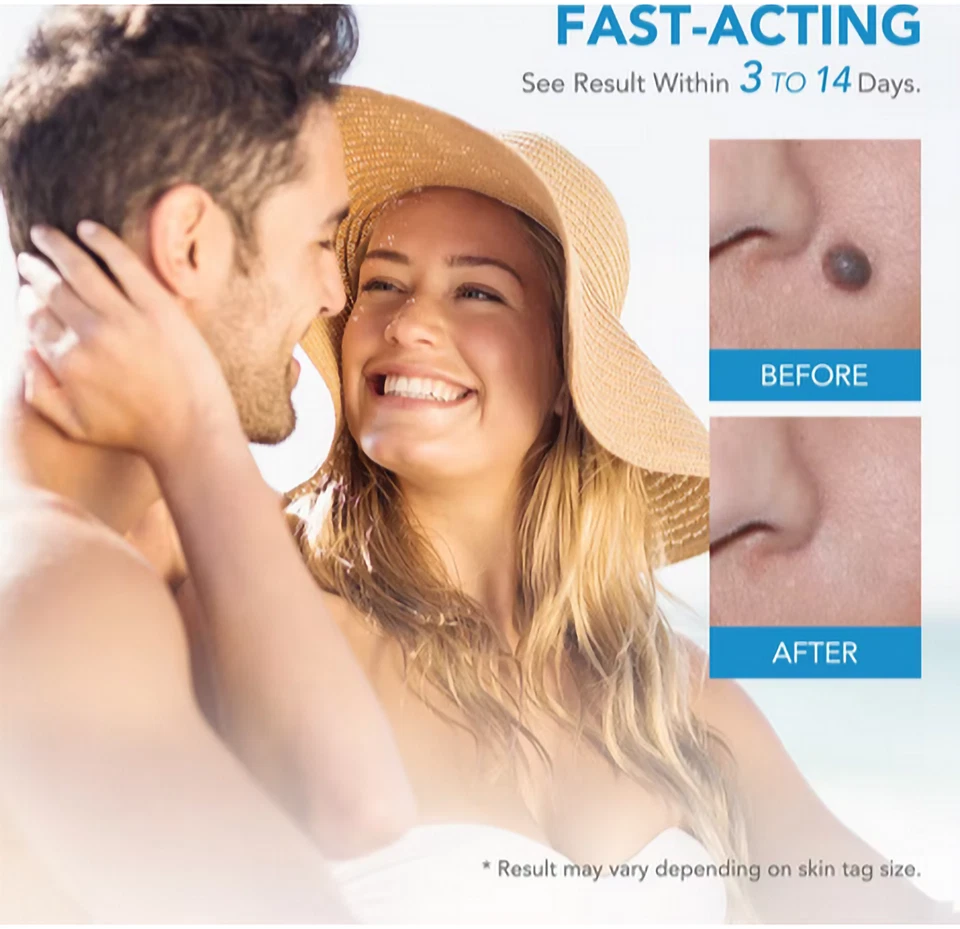 HOT Micro Skin Tag Removal Kit Mole Wart Remover Face Care Beauty Tools Painless - Image 4 of 4