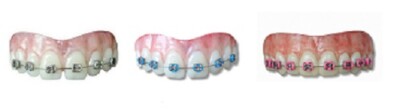 Gefälschte Zahnspange Nerd Streber Zähne Cosplay FX Dental Veneers SFX Zahnersatz Lemmy Effekte