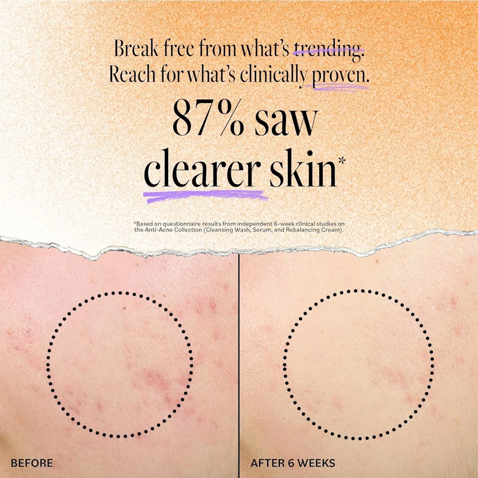 Derma E Jabón Limpiador Profundo de Poros para Acné - Limpiador Facial Control de Manchas con...  Foto 3 de 4