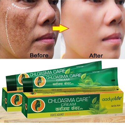 Hyperpigmentation, Blemishes Removal Chloasma Care Herbal Cream - 30 gm
