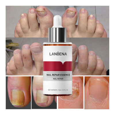 LANBENA Nail Repair Essence Serum Fungus Removal Feet Anti Infection Paronychia