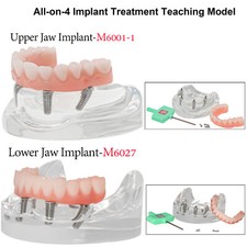 Dental Overdenture Implant All-on-4 Model Upper/Lower Jaw-Clear With 4 Screws