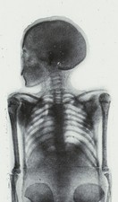 Magic Lantern Dia - Full Human Radiograph, X-ray by Messers, C & G / Newton